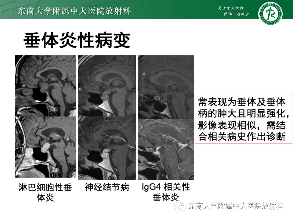 影像PPT - 【PPT】常见鞍内占位影像诊断-23