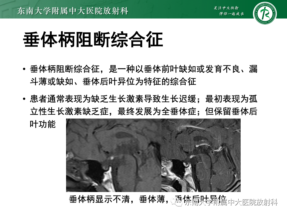 影像PPT - 【PPT】常见鞍内占位影像诊断-24