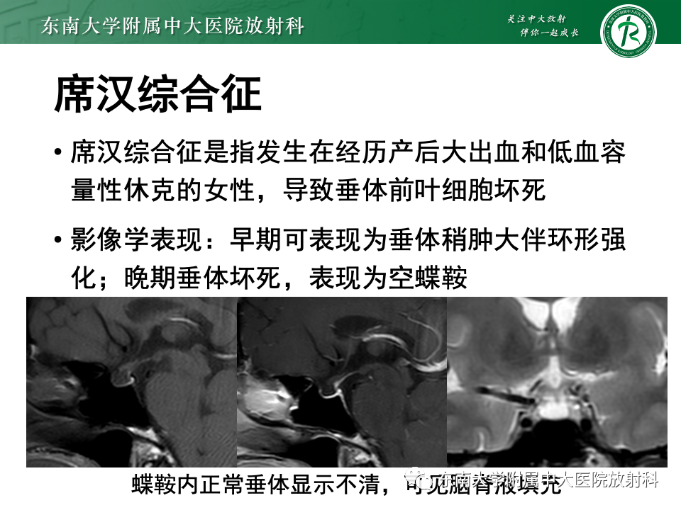 影像PPT - 【PPT】常见鞍内占位影像诊断-25