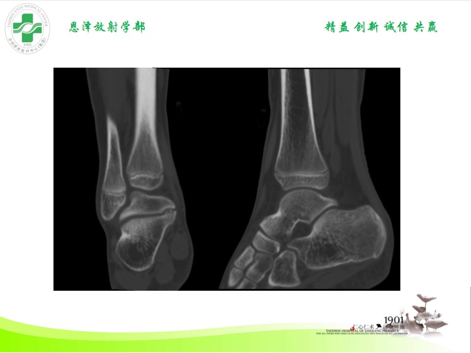 影像PPT - 【PPT】跟骨距骨桥-16