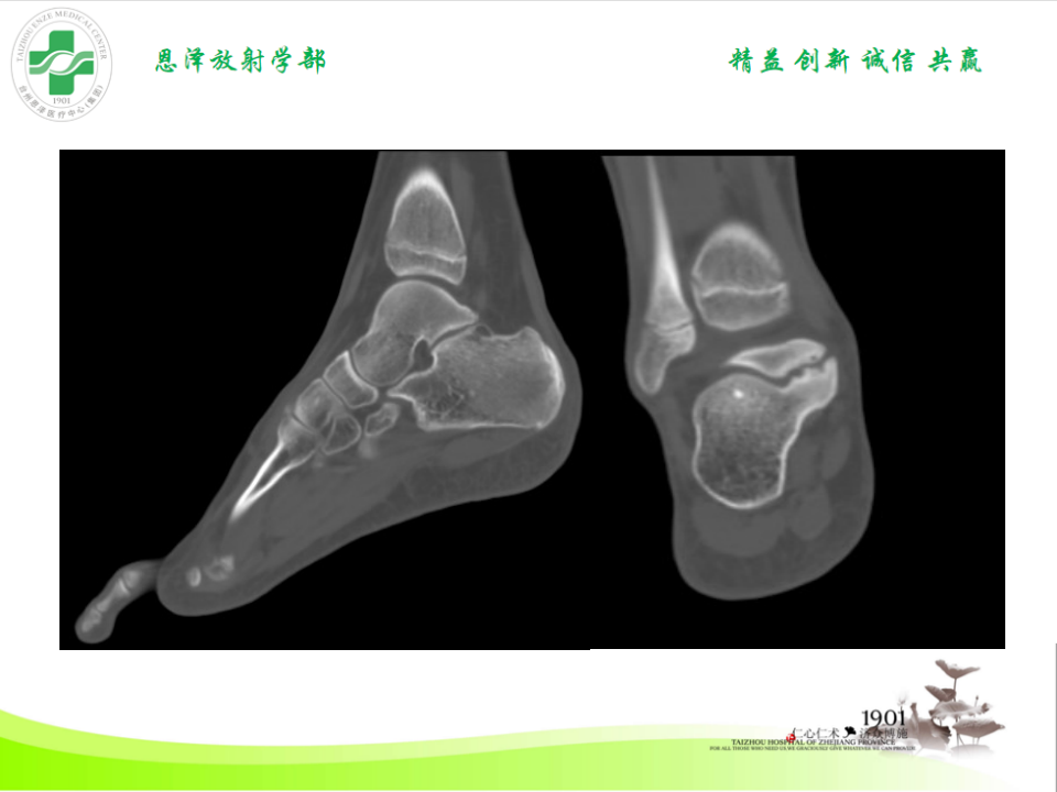影像PPT - 【PPT】跟骨距骨桥-17