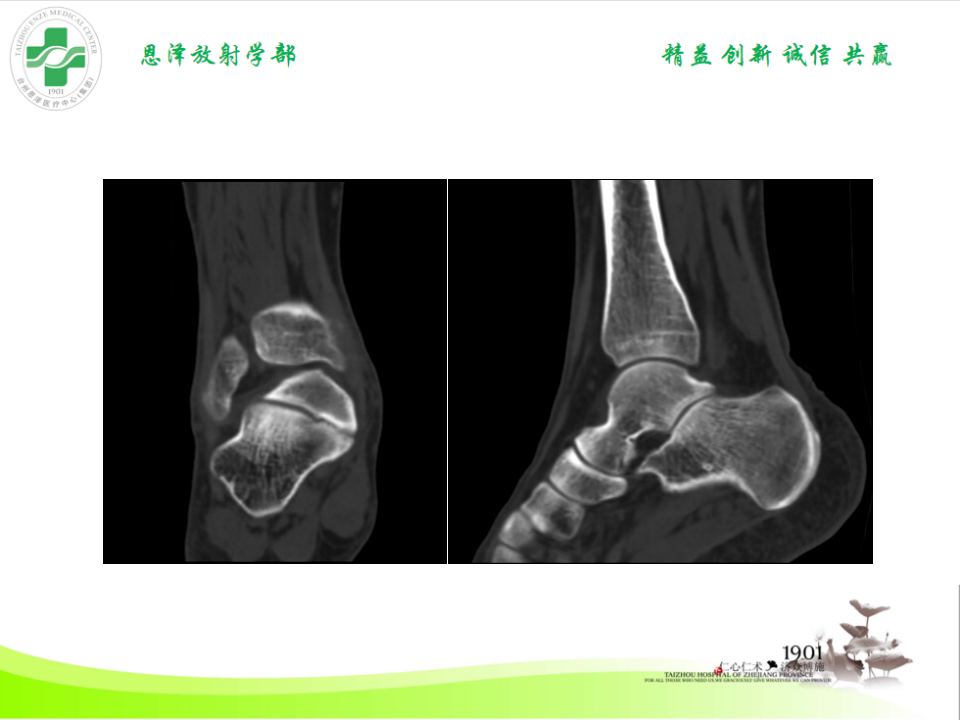 影像PPT - 【PPT】跟骨距骨桥-18