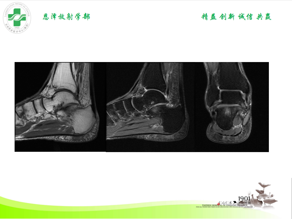影像PPT - 【PPT】跟骨距骨桥-20