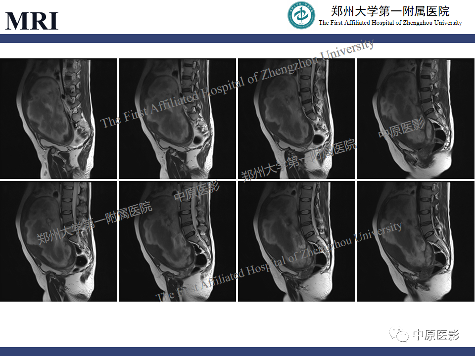 影像PPT - 【病例】子宫肌瘤红色出血变性1例MR-4