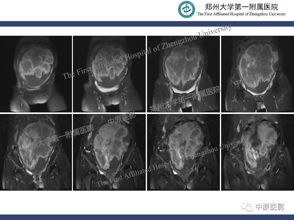 影像PPT - 【病例】子宫肌瘤红色出血变性1例MR-5