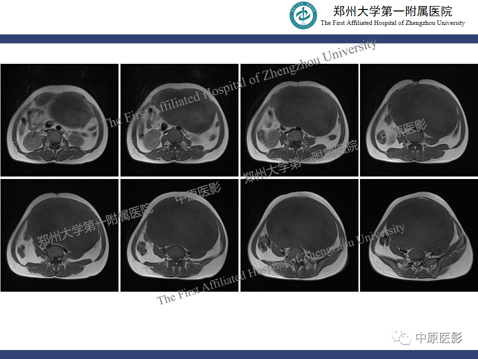 影像PPT - 【病例】子宫肌瘤红色出血变性1例MR-6