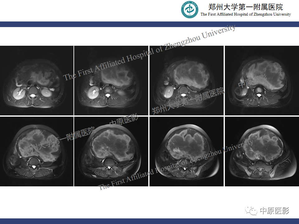影像PPT - 【病例】子宫肌瘤红色出血变性1例MR-7