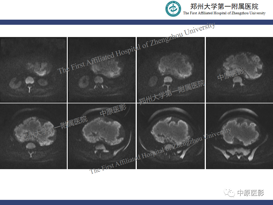 影像PPT - 【病例】子宫肌瘤红色出血变性1例MR-8