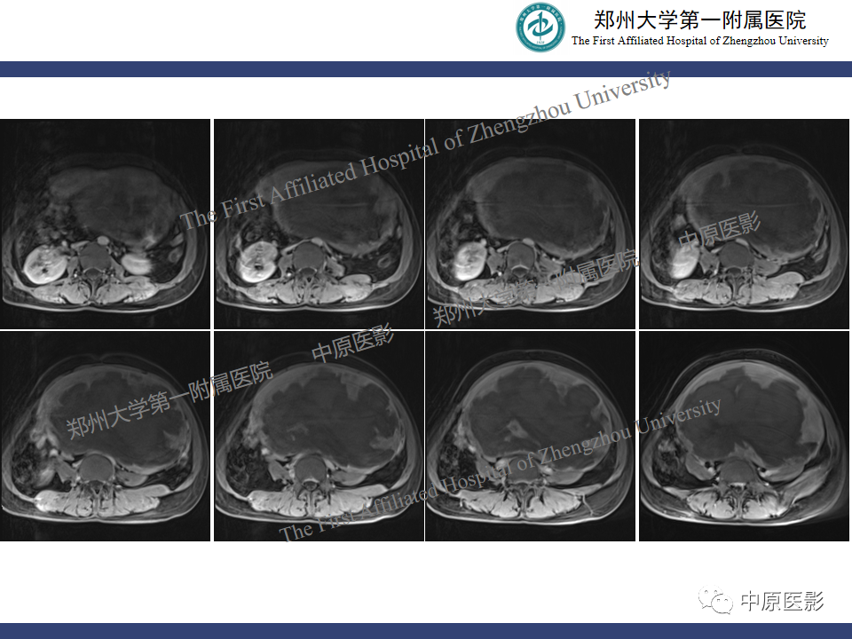 影像PPT - 【病例】子宫肌瘤红色出血变性1例MR-10