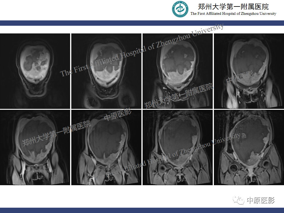 影像PPT - 【病例】子宫肌瘤红色出血变性1例MR-11