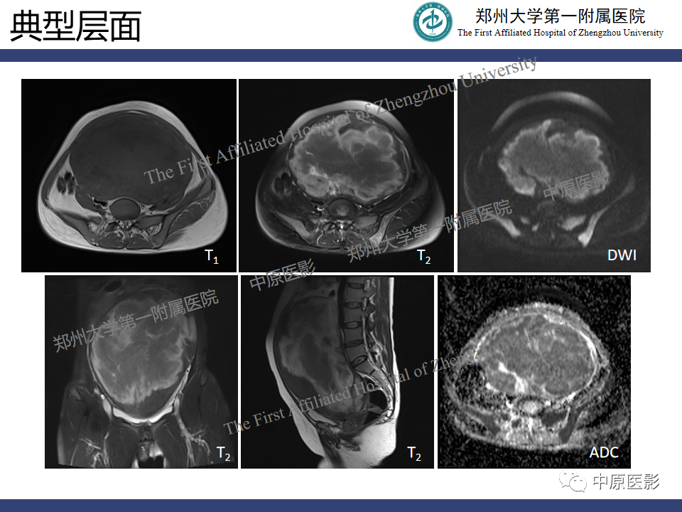 影像PPT - 【病例】子宫肌瘤红色出血变性1例MR-13