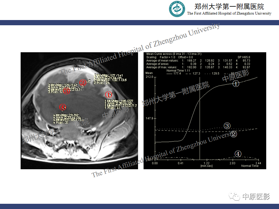 影像PPT - 【病例】子宫肌瘤红色出血变性1例MR-15