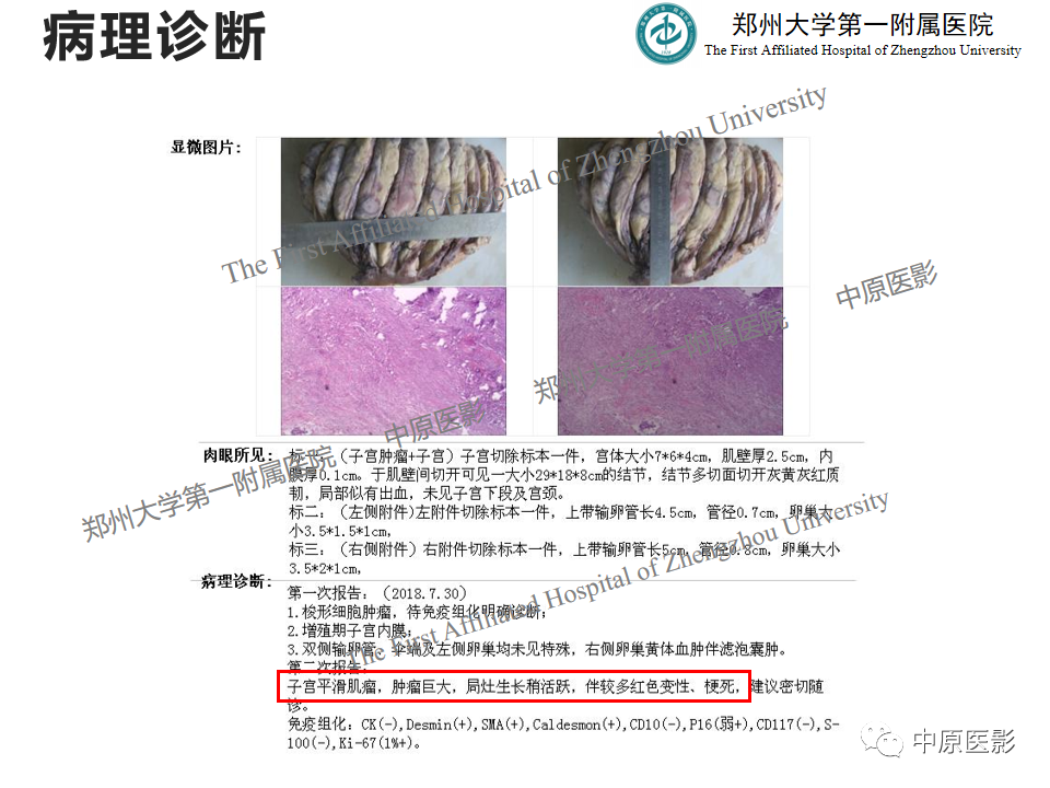 影像PPT - 【病例】子宫肌瘤红色出血变性1例MR-18