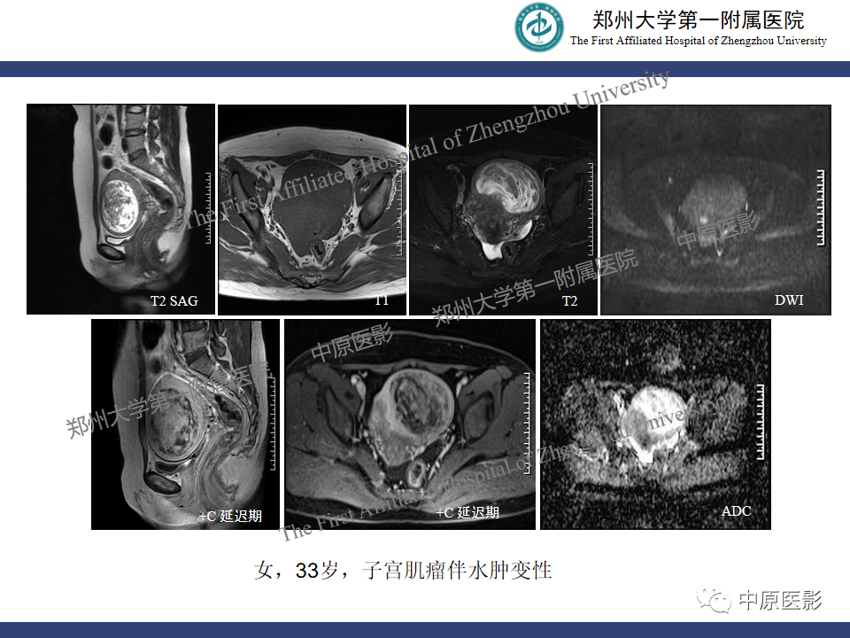 影像PPT - 【病例】子宫肌瘤红色出血变性1例MR-30