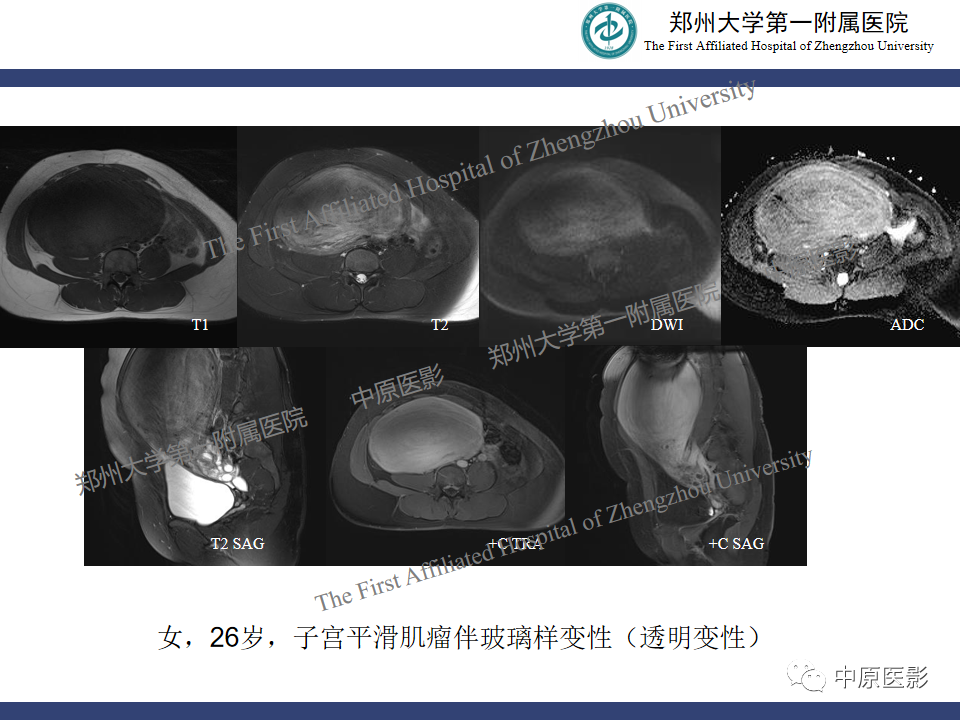 影像PPT - 【病例】子宫肌瘤红色出血变性1例MR-29