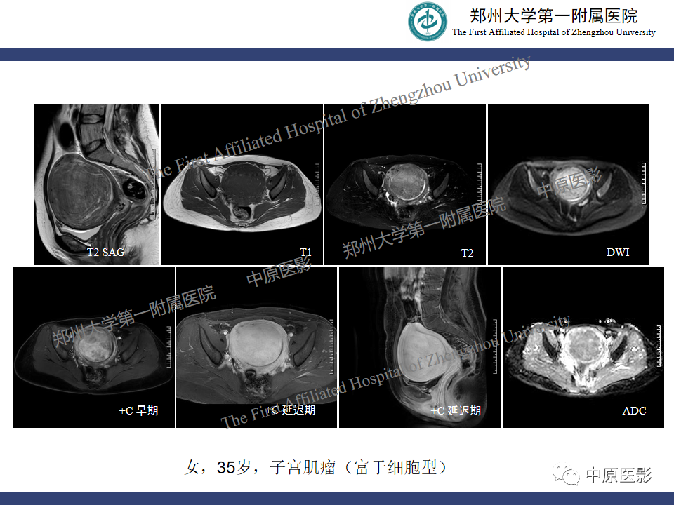 影像PPT - 【病例】子宫肌瘤红色出血变性1例MR-28