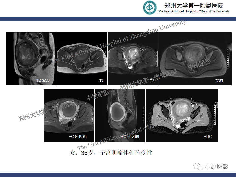 影像PPT - 【病例】子宫肌瘤红色出血变性1例MR-31
