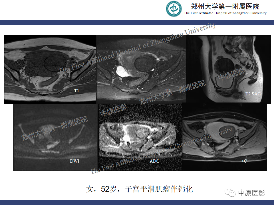 影像PPT - 【病例】子宫肌瘤红色出血变性1例MR-32
