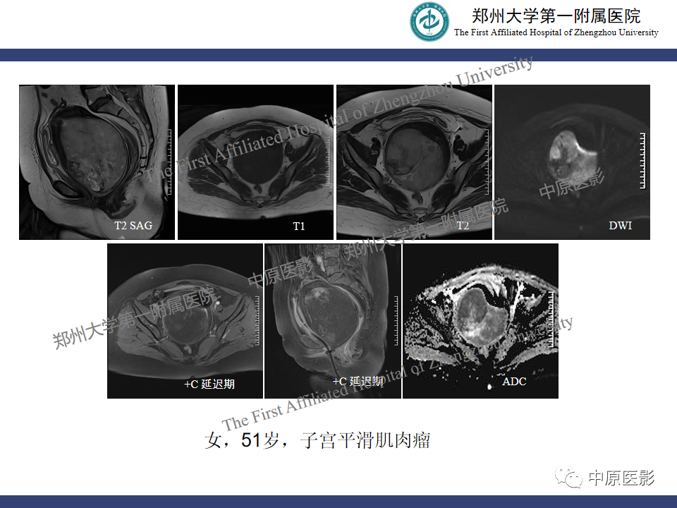 影像PPT - 【病例】子宫肌瘤红色出血变性1例MR-36