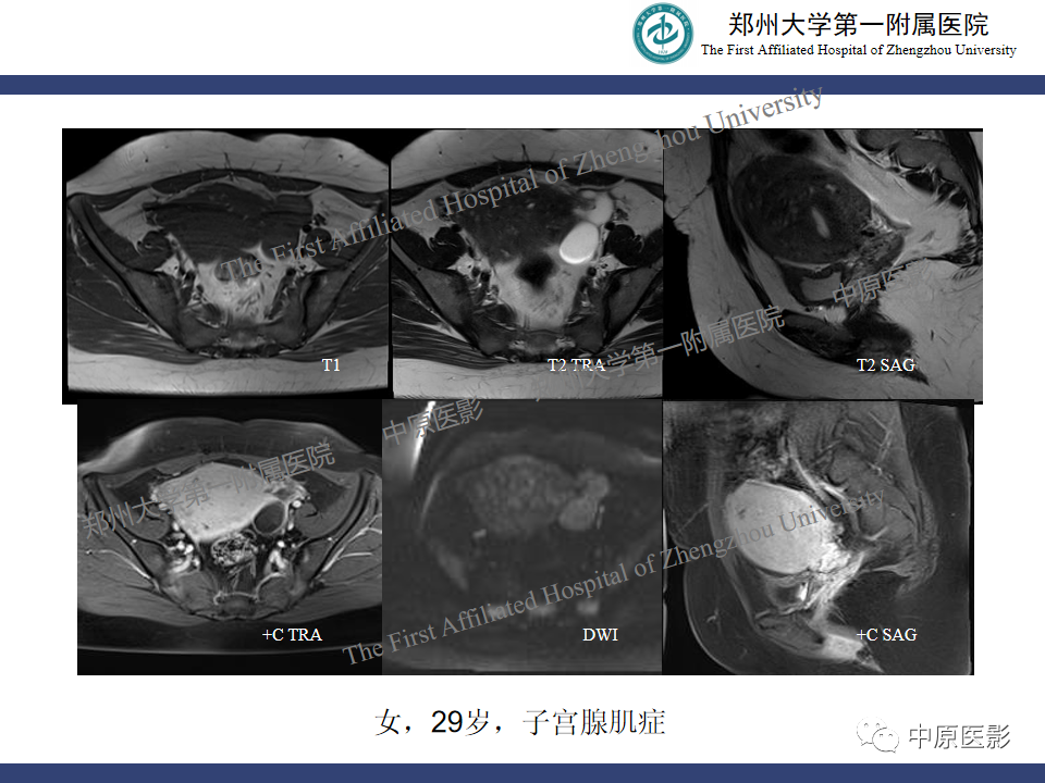 影像PPT - 【病例】子宫肌瘤红色出血变性1例MR-34