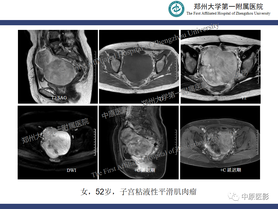 影像PPT - 【病例】子宫肌瘤红色出血变性1例MR-37
