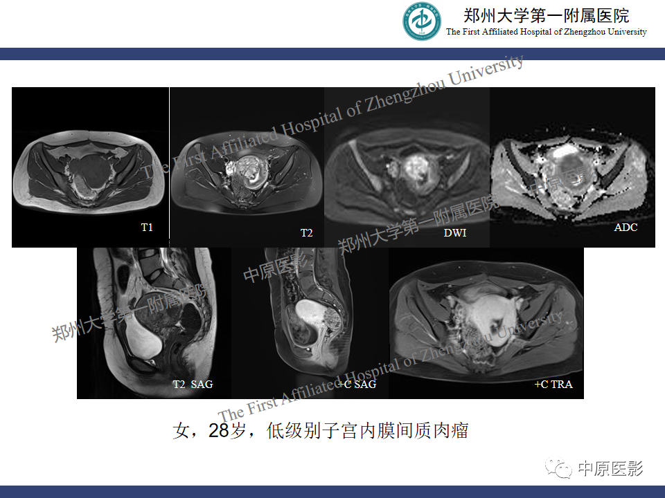 影像PPT - 【病例】子宫肌瘤红色出血变性1例MR-38