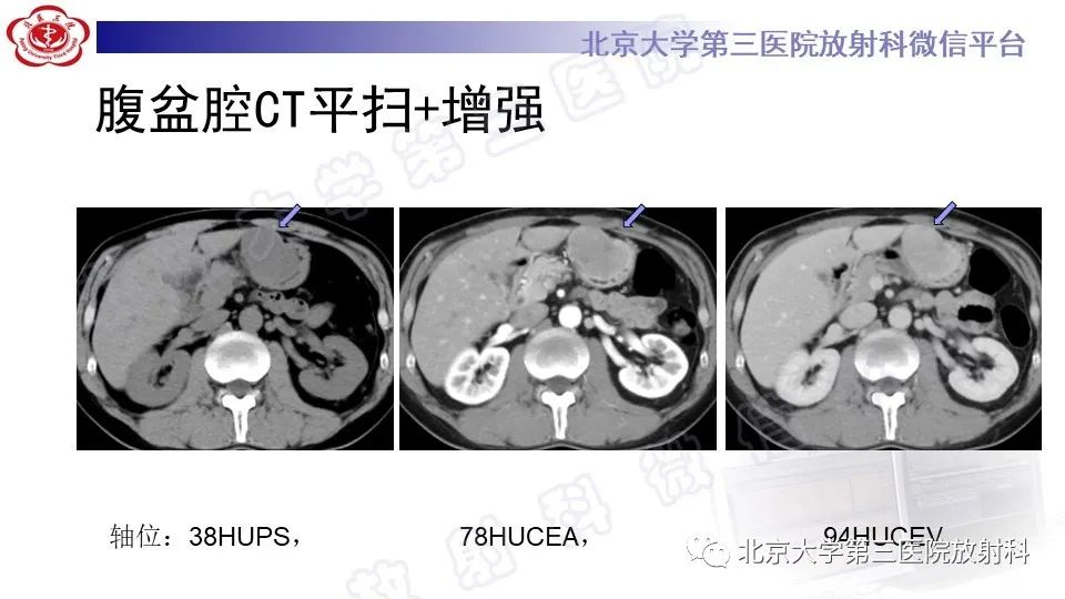 影像PPT - 【PPT】胃神经鞘瘤-3