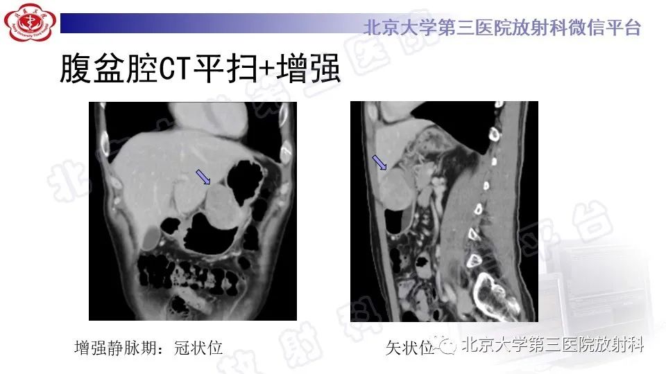 影像PPT - 【PPT】胃神经鞘瘤-4