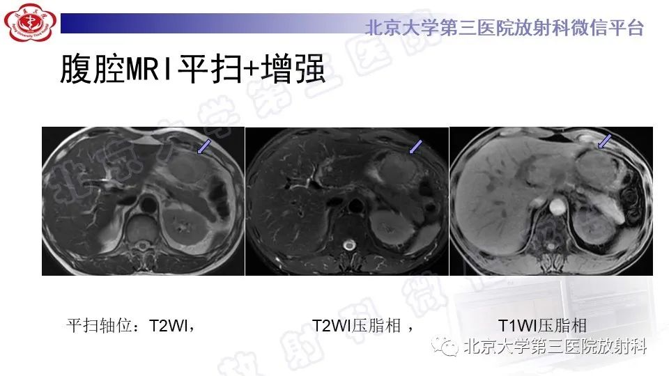 影像PPT - 【PPT】胃神经鞘瘤-5