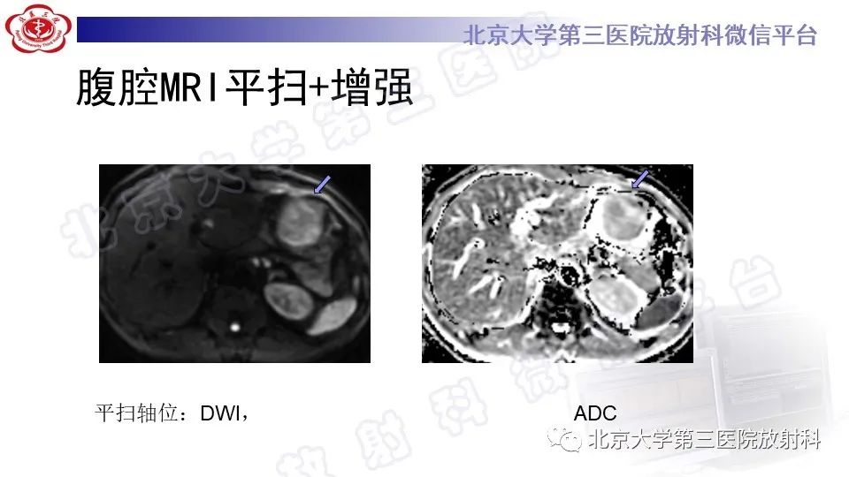 影像PPT - 【PPT】胃神经鞘瘤-6