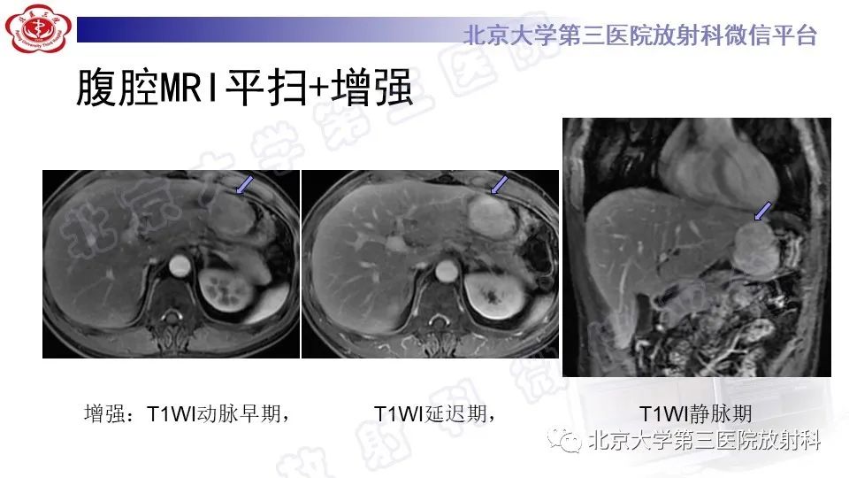 影像PPT - 【PPT】胃神经鞘瘤-7
