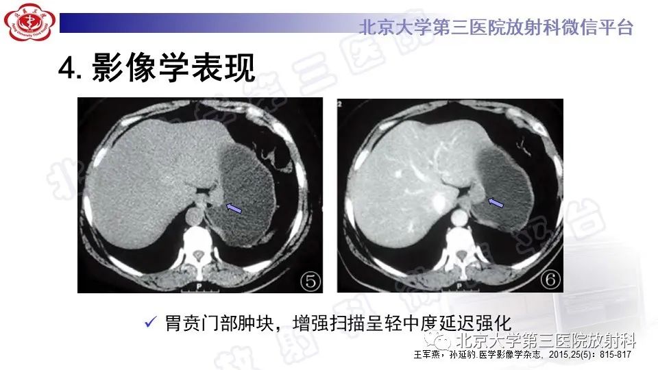 影像PPT - 【PPT】胃神经鞘瘤-17