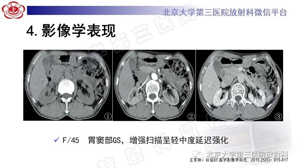 影像PPT - 【PPT】胃神经鞘瘤-16