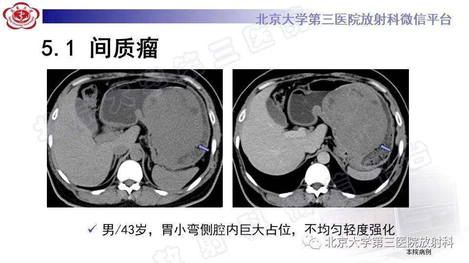 影像PPT - 【PPT】胃神经鞘瘤-21