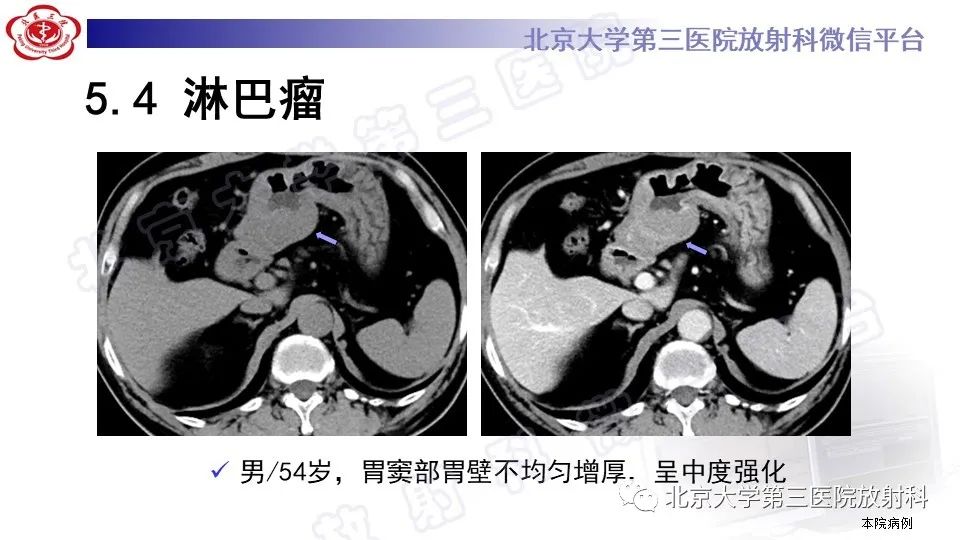 影像PPT - 【PPT】胃神经鞘瘤-25