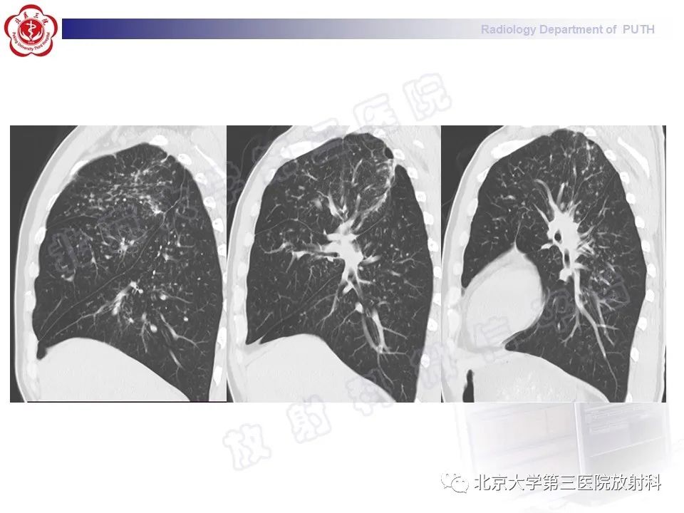 影像PPT - 【PPT】矽肺-6