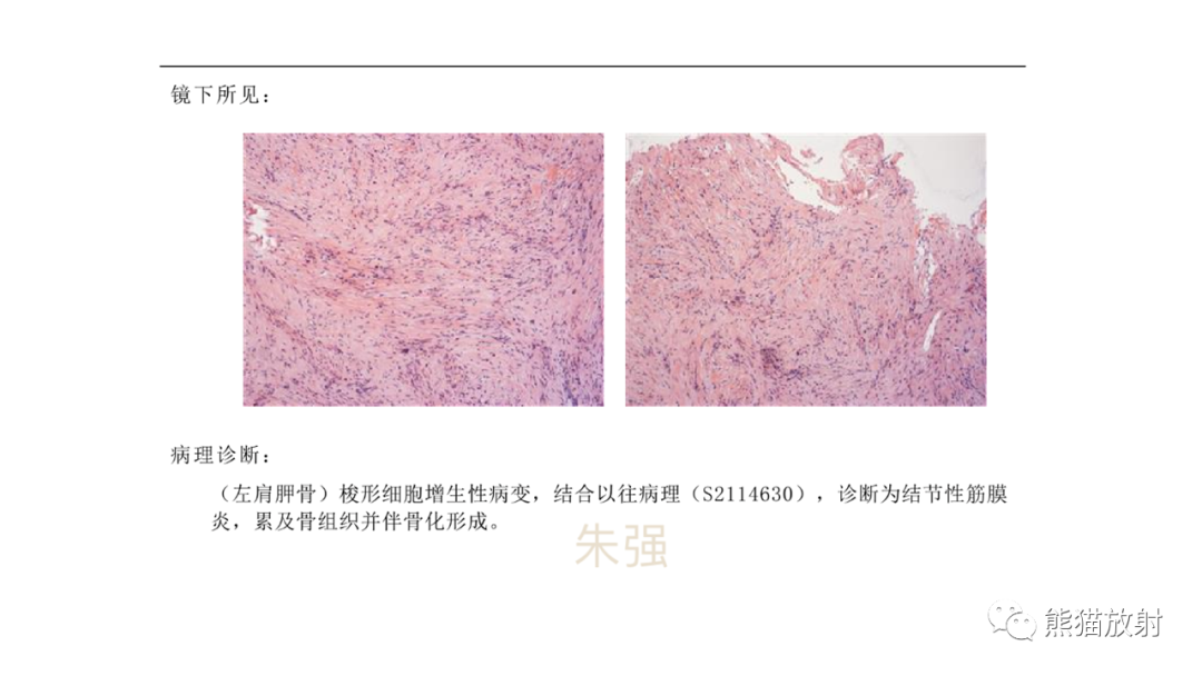 影像PPT - 【病例】结节性筋膜炎2例CT及MR影像-15