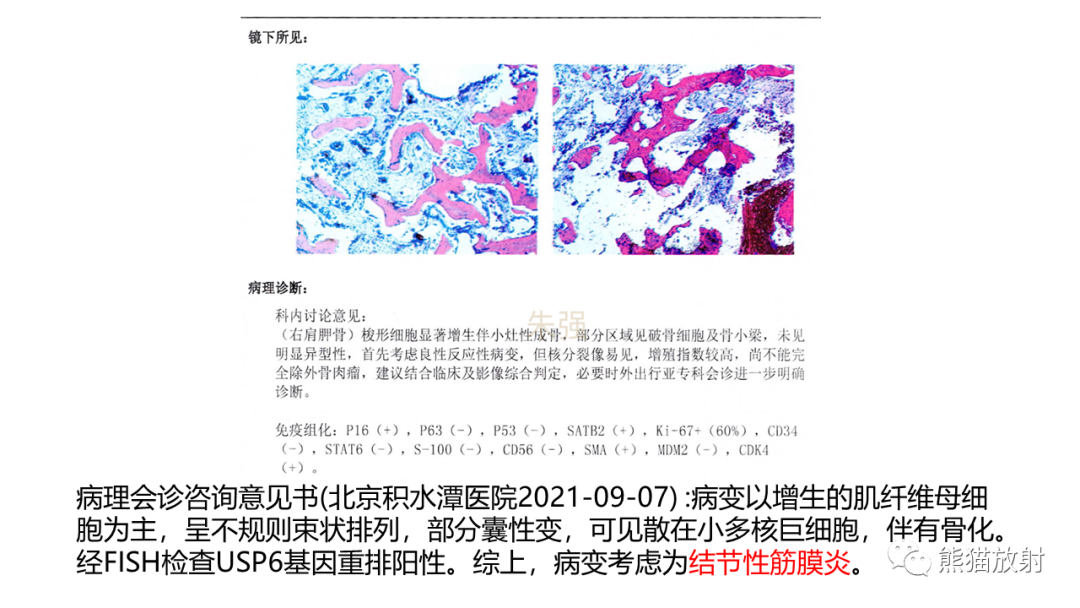 影像PPT - 【病例】结节性筋膜炎2例CT及MR影像-14