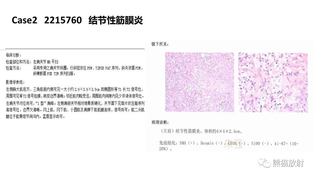 影像PPT - 【病例】结节性筋膜炎2例CT及MR影像-16