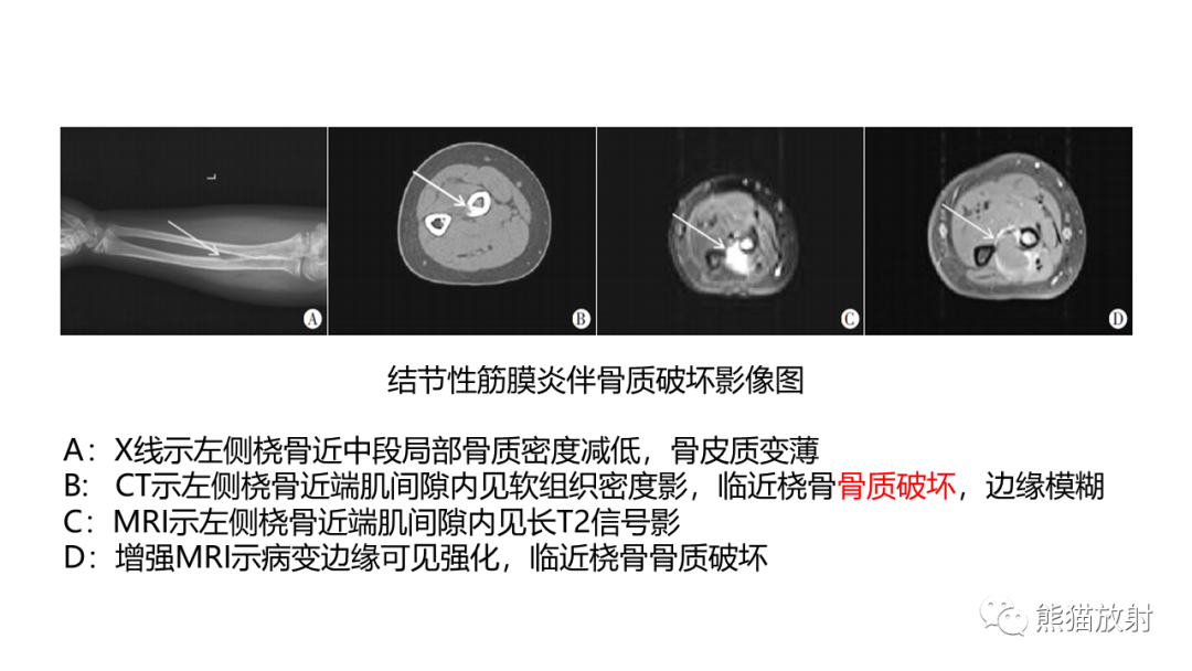 影像PPT - 【病例】结节性筋膜炎2例CT及MR影像-20