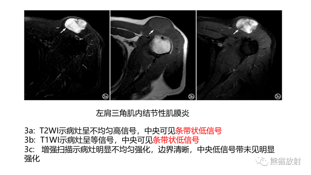 影像PPT - 【病例】结节性筋膜炎2例CT及MR影像-21