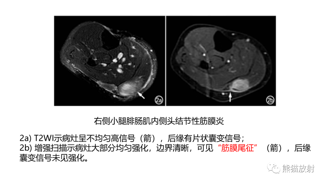 影像PPT - 【病例】结节性筋膜炎2例CT及MR影像-22