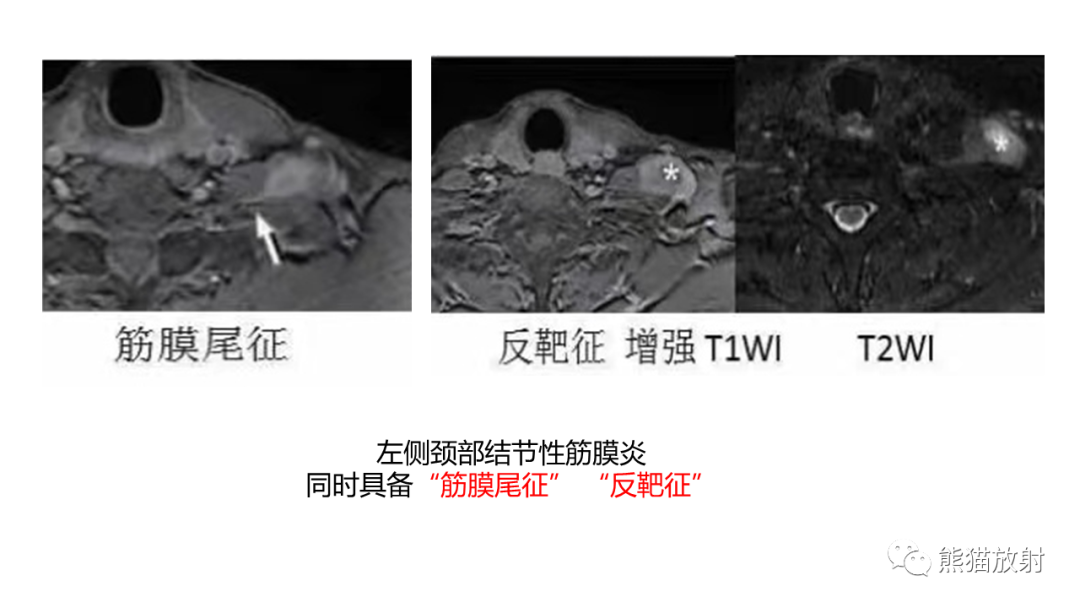 影像PPT - 【病例】结节性筋膜炎2例CT及MR影像-23