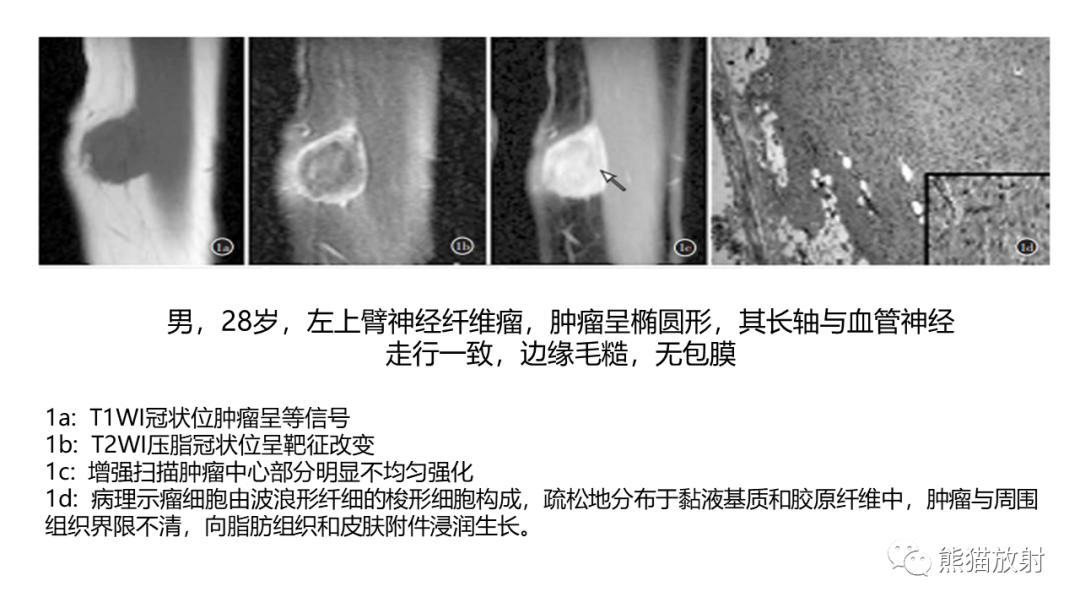 影像PPT - 【病例】结节性筋膜炎2例CT及MR影像-26