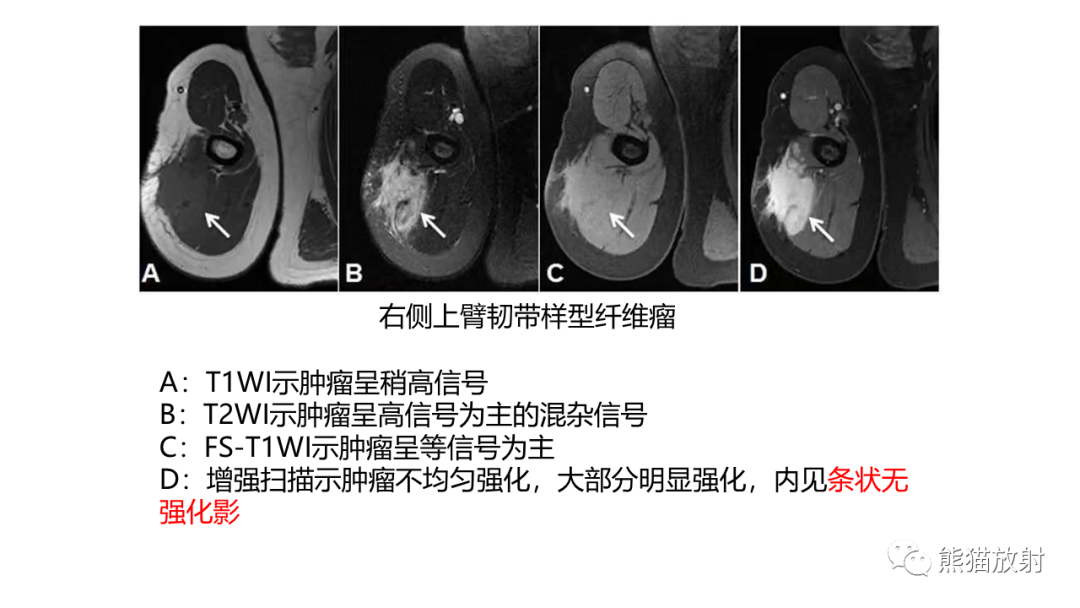 影像PPT - 【病例】结节性筋膜炎2例CT及MR影像-28