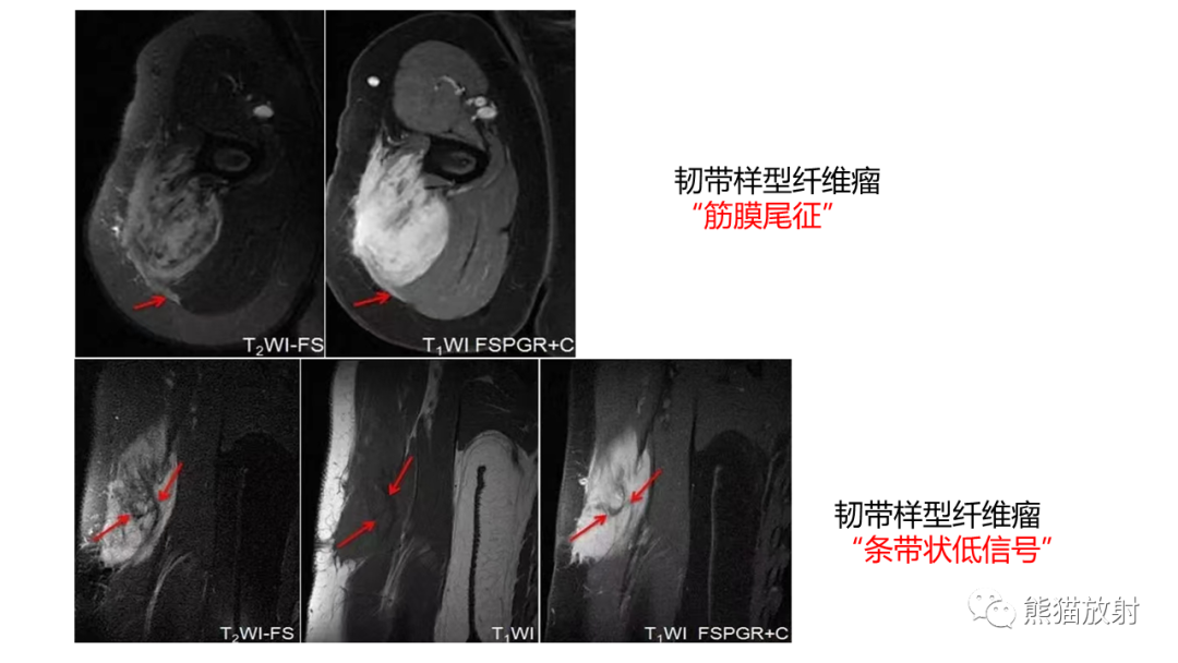 影像PPT - 【病例】结节性筋膜炎2例CT及MR影像-29