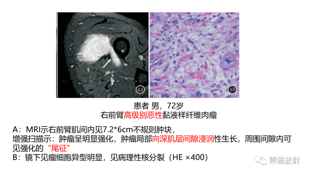影像PPT - 【病例】结节性筋膜炎2例CT及MR影像-31
