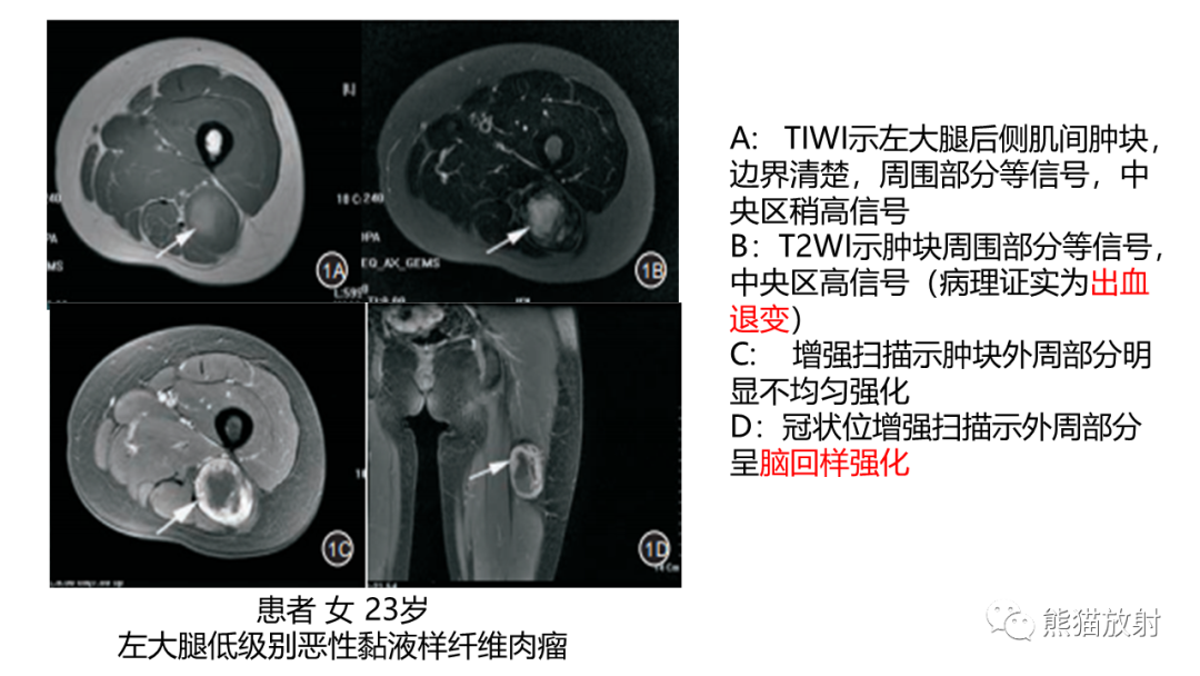 影像PPT - 【病例】结节性筋膜炎2例CT及MR影像-32