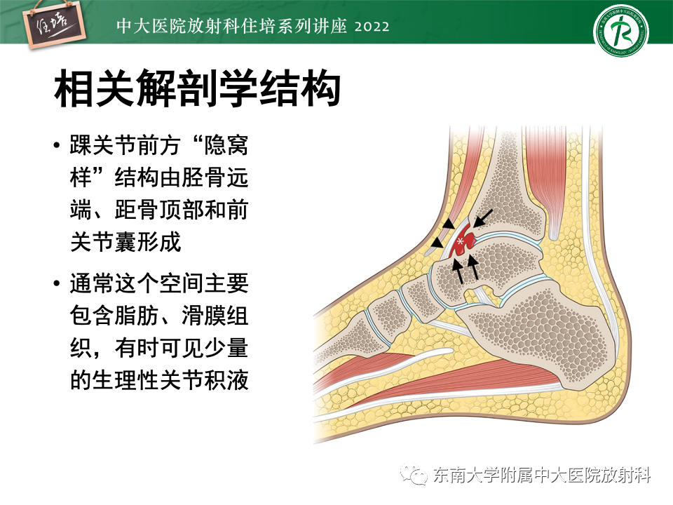 影像PPT - 【PPT】踝关节撞击综合征-6