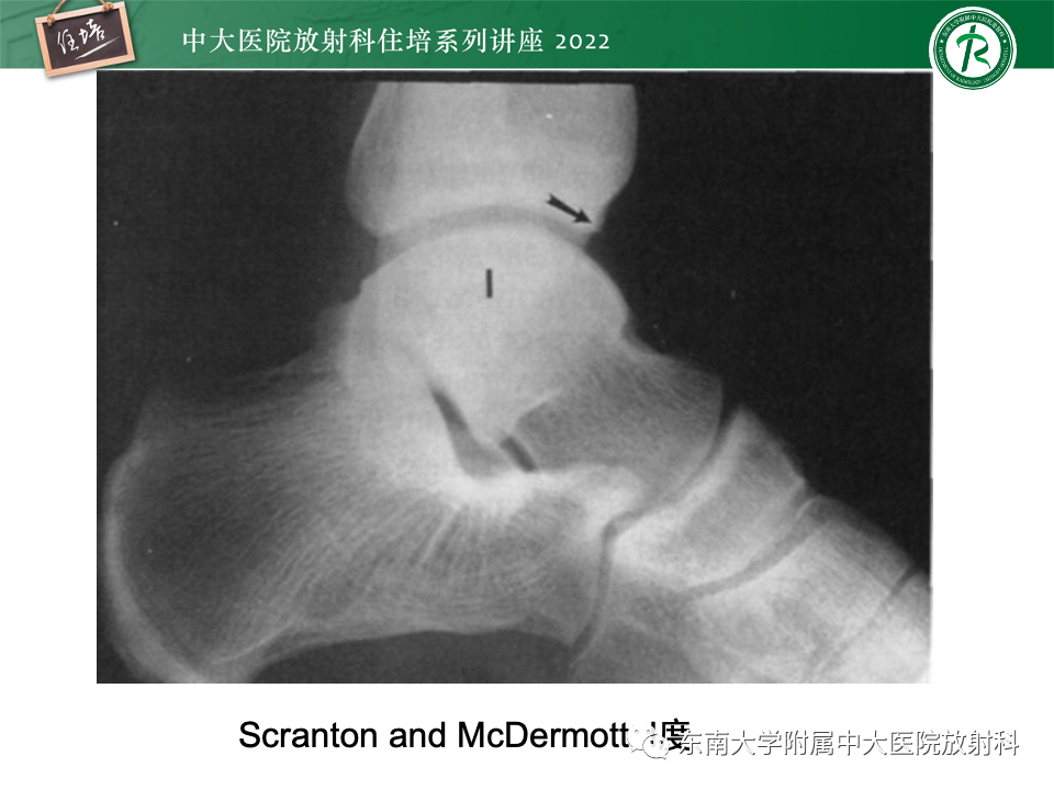 影像PPT - 【PPT】踝关节撞击综合征-11
